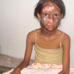 Menina cristã queimada